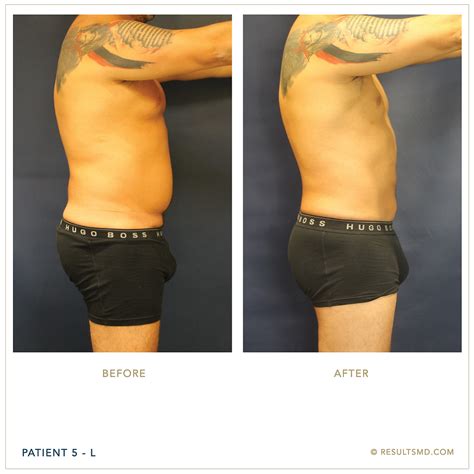 male liposuction miami|Best Male Liposuction Miami, FL 